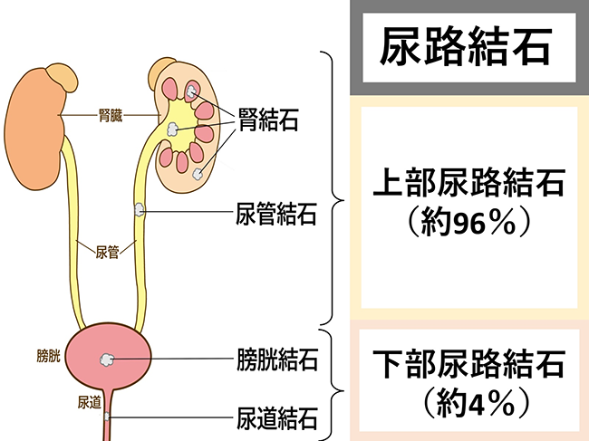 尿路結石